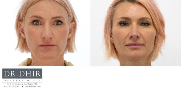 45 year old female presents for primary rhinoplasty with nasal hump, over projected, bulbous and unsupported nasal tip.  Open rhinoplasty was performed with hump removal, deviated nasal septum repair and deprojection with rotation of nasal tip.  The nostrils were narrowed with alar wedge resection.