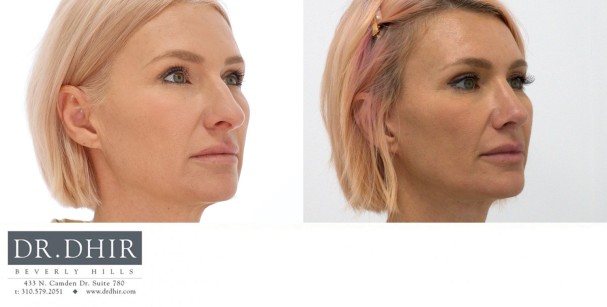 45 year old female presents for primary rhinoplasty with nasal hump, over projected, bulbous and unsupported nasal tip.  Open rhinoplasty was performed with hump removal, deviated nasal septum repair and deprojection with rotation of nasal tip.  The nostrils were narrowed with alar wedge resection.