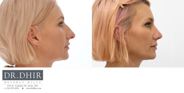 45 year old female presents for primary rhinoplasty with nasal hump, over projected, bulbous and unsupported nasal tip.  Open rhinoplasty was performed with hump removal, deviated nasal septum repair and deprojection with rotation of nasal tip.  The nostrils were narrowed with alar wedge resection.