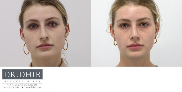 25 year old female presents with nasal hump, deviated nasal septum, over projected and droopy nasal tip with columellar hang. Open rhinoplasty was performed to straighten the septum, remove the nasal hump, and support the nasal tip with deprojection complex maneuvers with cartilage grafting.