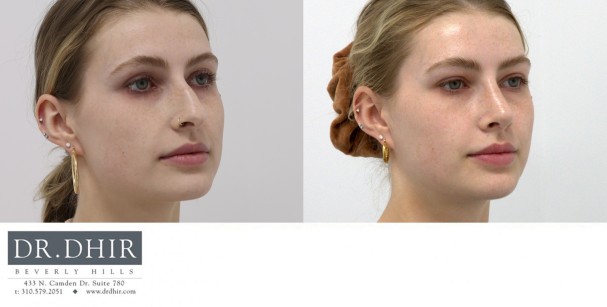 25 year old female presents with nasal hump, deviated nasal septum, over projected and droopy nasal tip with columellar hang. Open rhinoplasty was performed to straighten the septum, remove the nasal hump, and support the nasal tip with deprojection complex maneuvers with cartilage grafting.