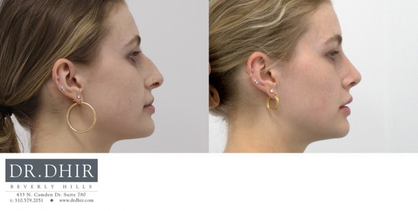 25 year old female presents with nasal hump, deviated nasal septum, over projected and droopy nasal tip with columellar hang. Open rhinoplasty was performed to straighten the septum, remove the nasal hump, and support the nasal tip with deprojection complex maneuvers with cartilage grafting.