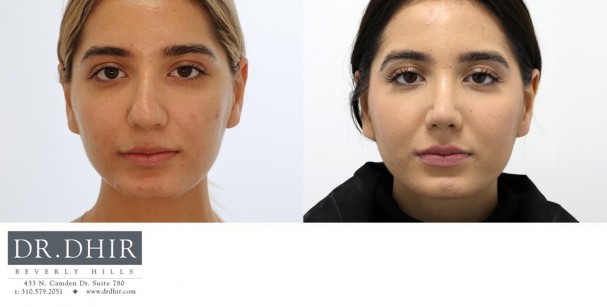 23 year old Middle Eastern female presents with nasal hump, thick nasal skin, crooked septum and bulbous unsupported droopy tip.  Open rhinoplasty was performed for hump removal, nostril reduction, tip refinement and rotation with cartilage grafting.