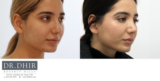 23 year old Middle Eastern female presents with nasal hump, thick nasal skin, crooked septum and bulbous unsupported droopy tip.  Open rhinoplasty was performed for hump removal, nostril reduction, tip refinement and rotation with cartilage grafting.