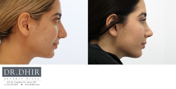 23 year old Middle Eastern female presents with nasal hump, thick nasal skin, crooked septum and bulbous unsupported droopy tip.  Open rhinoplasty was performed for hump removal, nostril reduction, tip refinement and rotation with cartilage grafting.