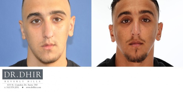 21 year old Middle Eastern Male with trauma to nose presents with crooked/deviated nasal septum, asymmetric nasal bones, nasal hump, bulbous and unsupported nasal tip. An open rhinoplasty was performed to straighten the nasal bones and septum, remove the nasal hump and refine the nasal tip with increased projection.