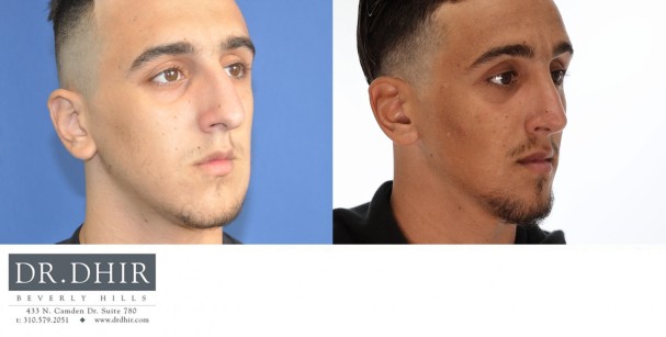 21 year old Middle Eastern Male with trauma to nose presents with crooked/deviated nasal septum, asymmetric nasal bones, nasal hump, bulbous and unsupported nasal tip. An open rhinoplasty was performed to straighten the nasal bones and septum, remove the nasal hump and refine the nasal tip with increased projection.