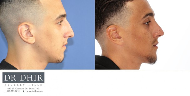 21 year old Middle Eastern Male with trauma to nose presents with crooked/deviated nasal septum, asymmetric nasal bones, nasal hump, bulbous and unsupported nasal tip. An open rhinoplasty was performed to straighten the nasal bones and septum, remove the nasal hump and refine the nasal tip with increased projection.