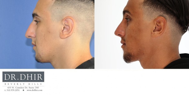 21 year old Middle Eastern Male with trauma to nose presents with crooked/deviated nasal septum, asymmetric nasal bones, nasal hump, bulbous and unsupported nasal tip. An open rhinoplasty was performed to straighten the nasal bones and septum, remove the nasal hump and refine the nasal tip with increased projection.