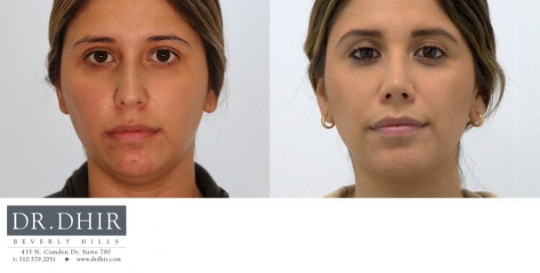 28 year old Hispanic female with nasal hump, deviated nasal septum and bulbous unsupported tip.  Open rhinoplasty was performed with hump removal, septal straightening and refinement of nasal tip with support