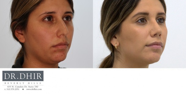 28 year old Hispanic female with nasal hump, deviated nasal septum and bulbous unsupported tip.  Open rhinoplasty was performed with hump removal, septal straightening and refinement of nasal tip with support