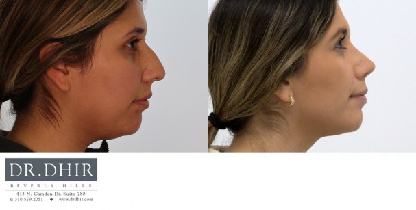 28 year old Hispanic female with nasal hump, deviated nasal septum and bulbous unsupported tip.  Open rhinoplasty was performed with hump removal, septal straightening and refinement of nasal tip with support