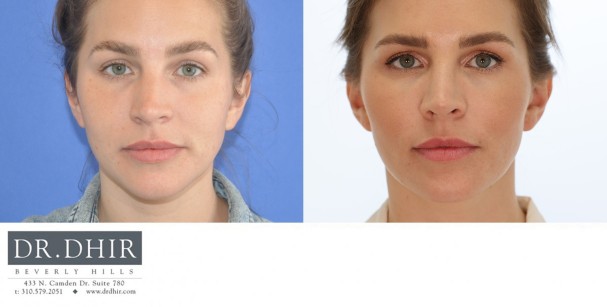 33 year old Female presents with crooked nasal septum and over projected nasal tip. Open rhinoplasty was performed with bridge contouring and deprojection of nasal tip with rotation.  The nostrils were narrowed with alar wedge resection.