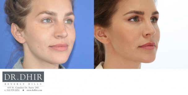 33 year old Female presents with crooked nasal septum and over projected nasal tip. Open rhinoplasty was performed with bridge contouring and deprojection of nasal tip with rotation.  The nostrils were narrowed with alar wedge resection.