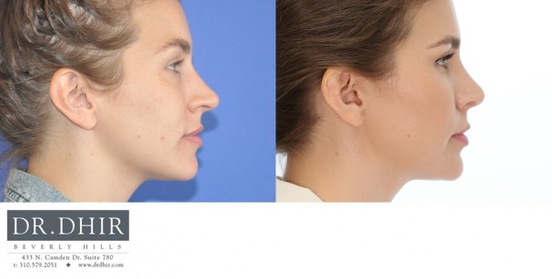 33 year old Female presents with crooked nasal septum and over projected nasal tip. Open rhinoplasty was performed with bridge contouring and deprojection of nasal tip with rotation.  The nostrils were narrowed with alar wedge resection.