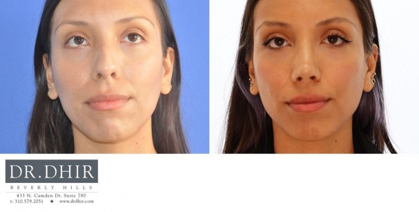 33 year old ethnic female with significant nasal hump, crooked nasal septum and unsupported nasal tip.  She underwent open rhinoplasty with hump removal, septal straightening, and tip refinement with support.  The nostrils were narrowed with alar base reduction.
