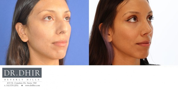 33 year old ethnic female with significant nasal hump, crooked nasal septum and unsupported nasal tip.  She underwent open rhinoplasty with hump removal, septal straightening, and tip refinement with support.  The nostrils were narrowed with alar base reduction.