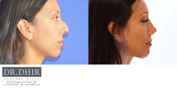 33 year old ethnic female with significant nasal hump, crooked nasal septum and unsupported nasal tip.  She underwent open rhinoplasty with hump removal, septal straightening, and tip refinement with support.  The nostrils were narrowed with alar base reduction.