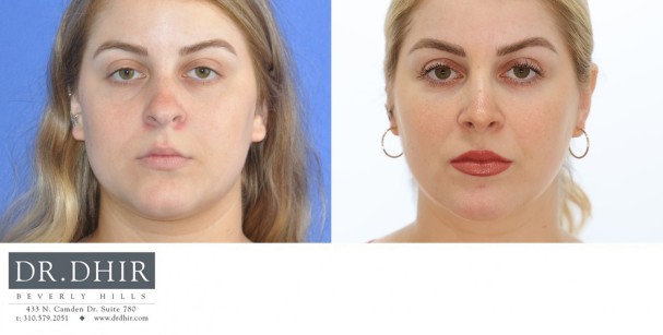 28 year old female with nasal hump, bulbous nasal tip, columellar show and nostril retraction.  Open rhinoplasty with nasal hump removal, deviated nasal septum correction, tip refinement with support and correction of nasal retraction for columellar show was performed.