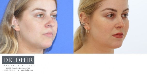 28 year old female with nasal hump, bulbous nasal tip, columellar show and nostril retraction.  Open rhinoplasty with nasal hump removal, deviated nasal septum correction, tip refinement with support and correction of nasal retraction for columellar show was performed.