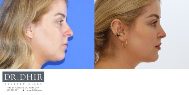 28 year old female with nasal hump, bulbous nasal tip, columellar show and nostril retraction.  Open rhinoplasty with nasal hump removal, deviated nasal septum correction, tip refinement with support and correction of nasal retraction for columellar show was performed.