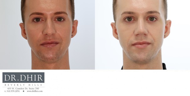 27 year old Male with nasal hump, crooked nasal septum and over projected nasal tip.  Open rhinoplasty was performed with hump removal, deprojection and rotation of nasal tip and nostril reduction with alar wedge resection.