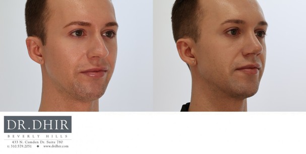27 year old Male with nasal hump, crooked nasal septum and over projected nasal tip.  Open rhinoplasty was performed with hump removal, deprojection and rotation of nasal tip and nostril reduction with alar wedge resection.