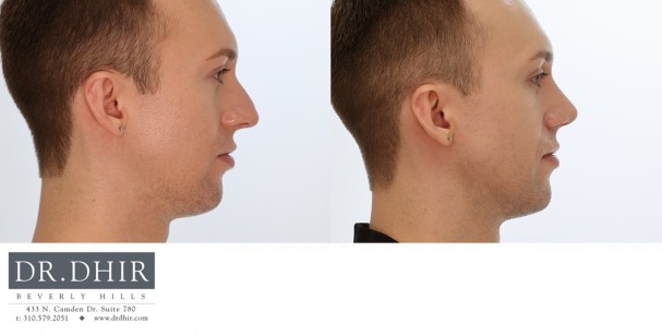 27 year old Male with nasal hump, crooked nasal septum and over projected nasal tip.  Open rhinoplasty was performed with hump removal, deprojection and rotation of nasal tip and nostril reduction with alar wedge resection.