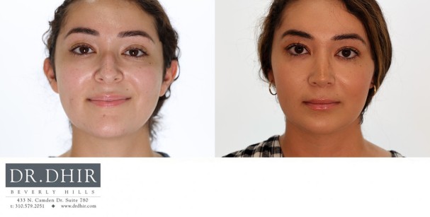 24 year old Hispanic female with nasal hump, bulbous nasal tip and unsupported nasal tip with active smile.  Open rhinoplasty was performed with septoplasty, hump reduction, tip refinement and nasal tip support with cartilage grafting.