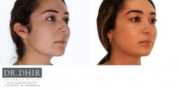 24 year old Hispanic female with nasal hump, bulbous nasal tip and unsupported nasal tip with active smile.  Open rhinoplasty was performed with septoplasty, hump reduction, tip refinement and nasal tip support with cartilage grafting.