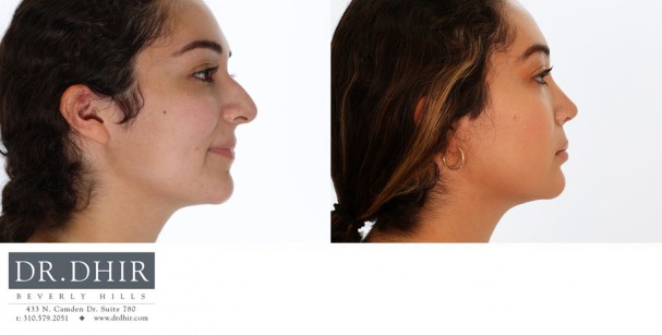 24 year old Hispanic female with nasal hump, bulbous nasal tip and unsupported nasal tip with active smile.  Open rhinoplasty was performed with septoplasty, hump reduction, tip refinement and nasal tip support with cartilage grafting.