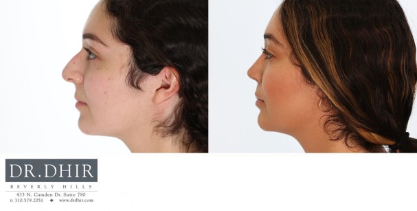 24 year old Hispanic female with nasal hump, bulbous nasal tip and unsupported nasal tip with active smile.  Open rhinoplasty was performed with septoplasty, hump reduction, tip refinement and nasal tip support with cartilage grafting.