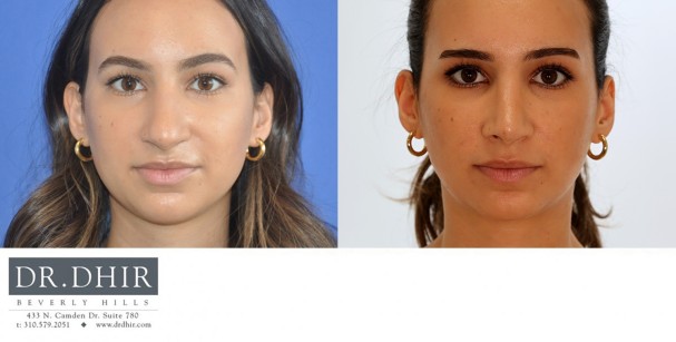 26 year old Middle Eastern female with thick skin presents with nasal hump, crooked nasal septum and a bulbous, over projected nasal tip.  She underwent open rhinoplasty with hump removal, deprojection and refinement of the nasal tip.  The tip was supported and the nostrils were narrowed with alar base reduction.