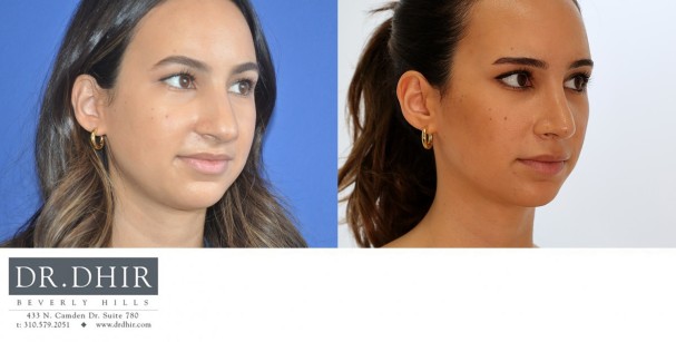 26 year old Middle Eastern female with thick skin presents with nasal hump, crooked nasal septum and a bulbous, over projected nasal tip.  She underwent open rhinoplasty with hump removal, deprojection and refinement of the nasal tip.  The tip was supported and the nostrils were narrowed with alar base reduction.