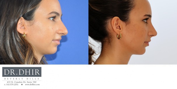 26 year old Middle Eastern female with thick skin presents with nasal hump, crooked nasal septum and a bulbous, over projected nasal tip.  She underwent open rhinoplasty with hump removal, deprojection and refinement of the nasal tip.  The tip was supported and the nostrils were narrowed with alar base reduction.