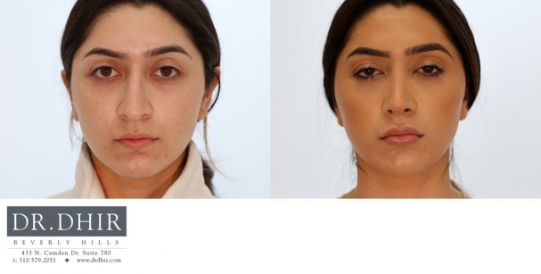 46 year old ethnic female presents with nasal hump, crooked nasal tip, and droopy unsupported nasal tip.  She underwent open rhinoplasty, nasal septum straightening, tip refinement, increased tip rotation with support and nostril refinement with alar wedge resection.