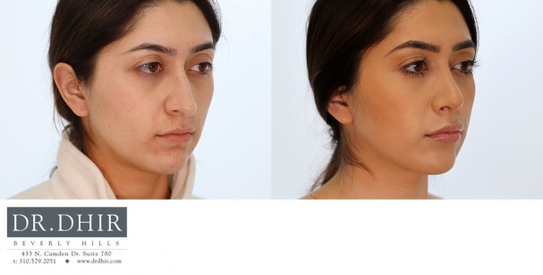46 year old ethnic female presents with nasal hump, crooked nasal tip, and droopy unsupported nasal tip.  She underwent open rhinoplasty, nasal septum straightening, tip refinement, increased tip rotation with support and nostril refinement with alar wedge resection.