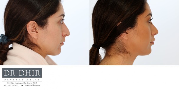 46 year old ethnic female presents with nasal hump, crooked nasal tip, and droopy unsupported nasal tip.  She underwent open rhinoplasty, nasal septum straightening, tip refinement, increased tip rotation with support and nostril refinement with alar wedge resection.