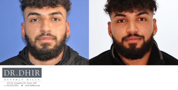 24 year old Hispanic male with nasal hump, thick skin, crooked nasal septum, wide nasal bones, bulbous and unsupported nasal tip with droopiness.  He underwent open rhinoplasty with nasal hump reduction, septal correction, trip refinement with projection and rotation, and nostril narrowing with alar wedge resection.
