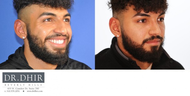 24 year old Hispanic male with nasal hump, thick skin, crooked nasal septum, wide nasal bones, bulbous and unsupported nasal tip with droopiness.  He underwent open rhinoplasty with nasal hump reduction, septal correction, trip refinement with projection and rotation, and nostril narrowing with alar wedge resection.