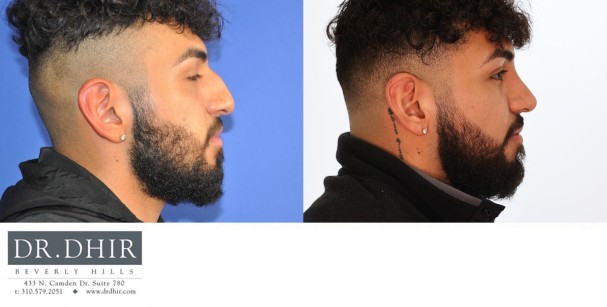 24 year old Hispanic male with nasal hump, thick skin, crooked nasal septum, wide nasal bones, bulbous and unsupported nasal tip with droopiness.  He underwent open rhinoplasty with nasal hump reduction, septal correction, trip refinement with projection and rotation, and nostril narrowing with alar wedge resection.