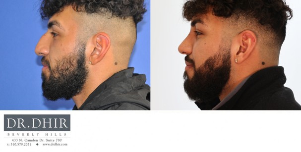 24 year old Hispanic male with nasal hump, thick skin, crooked nasal septum, wide nasal bones, bulbous and unsupported nasal tip with droopiness.  He underwent open rhinoplasty with nasal hump reduction, septal correction, trip refinement with projection and rotation, and nostril narrowing with alar wedge resection.