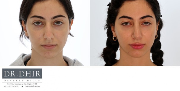26 year old Hispanic female with nasal hump and over projected nasal tip with poor rotation and bulbosity.  Open rhinoplasty with hump removal, nasal tip refinement, and tip projection with rotation was performed.