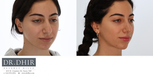26 year old Hispanic female with nasal hump and over projected nasal tip with poor rotation and bulbosity.  Open rhinoplasty with hump removal, nasal tip refinement, and tip projection with rotation was performed.