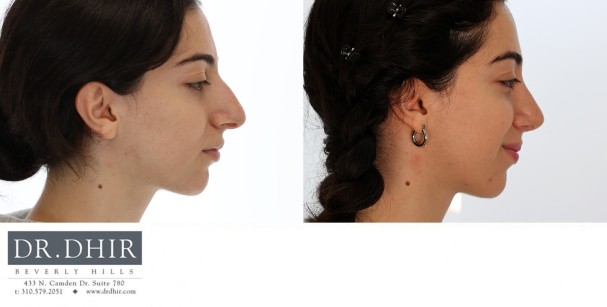 26 year old Hispanic female with nasal hump and over projected nasal tip with poor rotation and bulbosity.  Open rhinoplasty with hump removal, nasal tip refinement, and tip projection with rotation was performed.