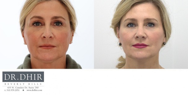 50 yr old female presents with nasal hump, under-rotated, droopy and bulbous tip.  She underwent open rhinoplasty with hump removal, nasal tip rotation with deprojection and nasal tip refinement.