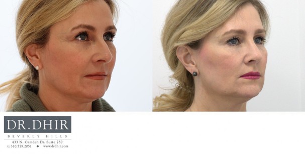 50 yr old female presents with nasal hump, under-rotated, droopy and bulbous tip.  She underwent open rhinoplasty with hump removal, nasal tip rotation with deprojection and nasal tip refinement.