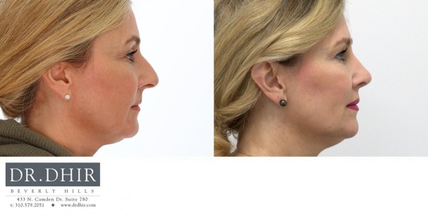 50 yr old female presents with nasal hump, under-rotated, droopy and bulbous tip.  She underwent open rhinoplasty with hump removal, nasal tip rotation with deprojection and nasal tip refinement.