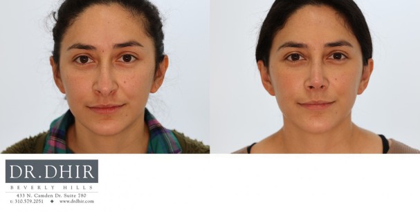 25 yr old Hispanic Female with nasal hump, under-rotated, droopy tip and mild columellar show.  The tip was refined, rotated and the nasal hump was removed.  A septoplasty was performed for breathing and straightening the nose.
