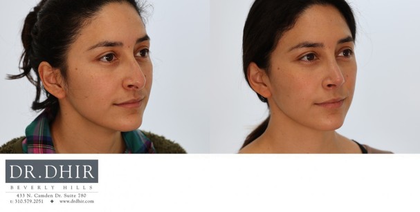 25 yr old Hispanic Female with nasal hump, under-rotated, droopy tip and mild columellar show.  The tip was refined, rotated and the nasal hump was removed.  A septoplasty was performed for breathing and straightening the nose.